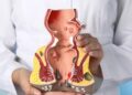 hemorrhoids