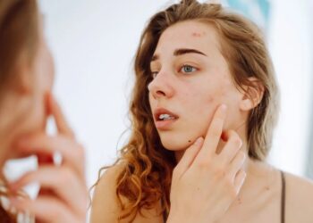 face indicate hormonal imbalance