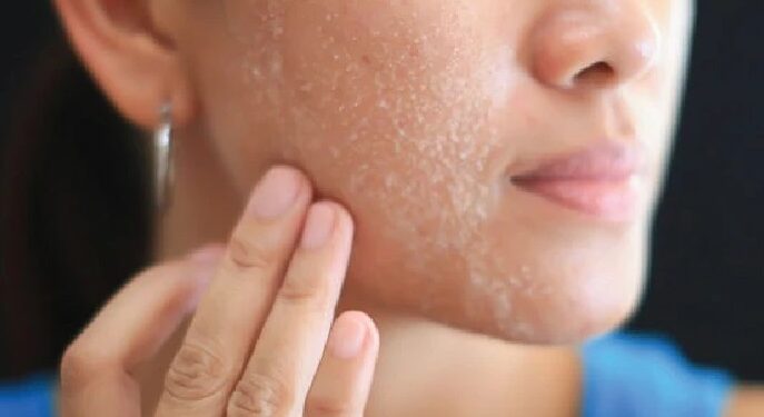 dry skin
