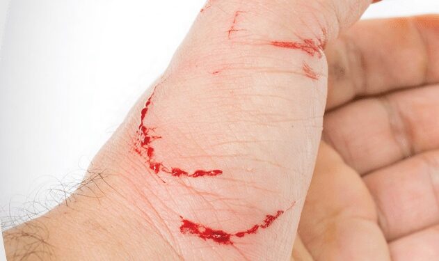 मानव रेबीज